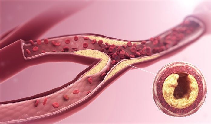 تجمع چربی و گرفتگی عروق قلب