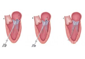 عمل ترمیم دریچه میترال بدون جراحی