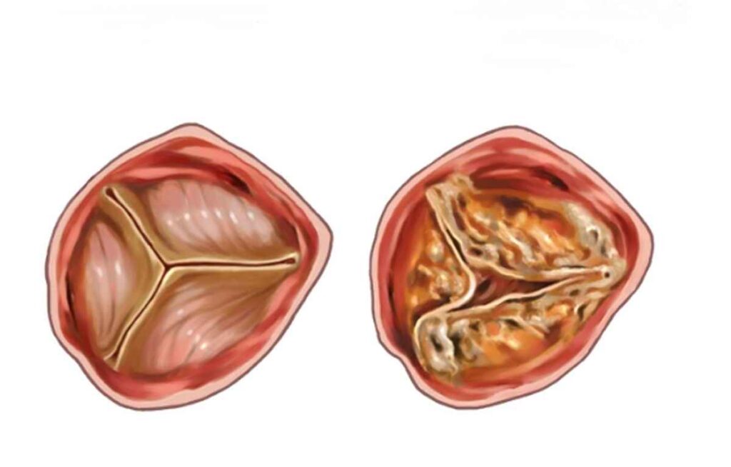 دریچه آئورت سالم و خراب