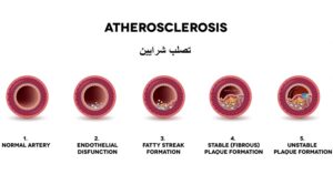 علائم تصلب شرایین