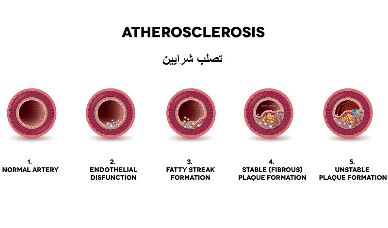 علائم تصلب شرایین